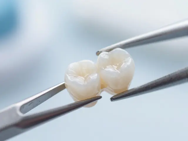 Fazety na zuby: Rizika, komplikace a na co si dát pozor