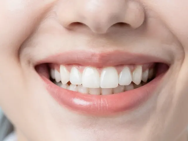 Jak často si bělit zuby? Bezpečné intervaly a doporučení