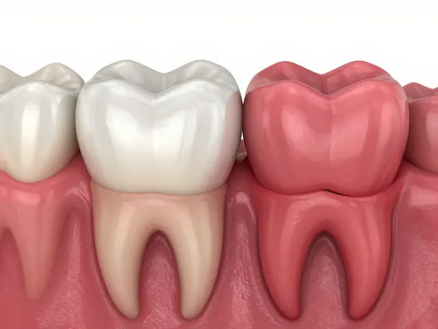 Jak vypadá paradentóza? Příznaky, rozdíly od zánětu dásní a léčba